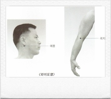 뜸 이미지