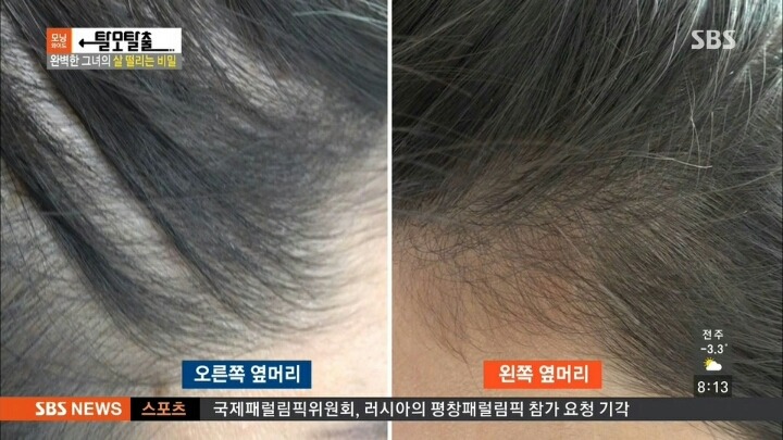 탈모가 고민인 여성 모델 | 인스티즈