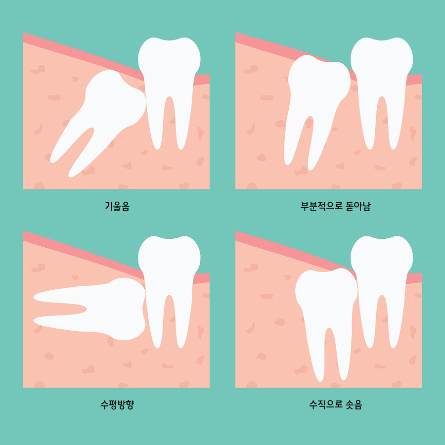 사랑니 발치 해보신 분들? (feat. dentist) (혐오주의) | 인스티즈