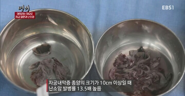 자궁내막조직이 자궁밖에 존재하는 자궁내막증.jpg | 인스티즈