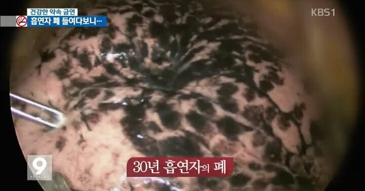 흡연자들의 폐 내시경.jpg (사진주의) | 인스티즈